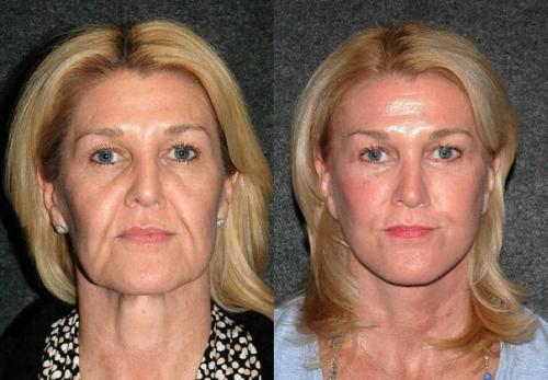 Как выглядят обычные женщины 50-70 лет, сделавшие подтяжку лица. 02