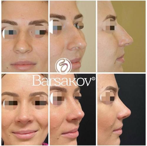 Таким образом, если ваш нос - вечный источник комплексов и плохого настроения, то после операции вы точно начнете оценивать себя по-другому. 08