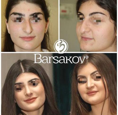 Таким образом, если ваш нос - вечный источник комплексов и плохого настроения, то после операции вы точно начнете оценивать себя по-другому. 07