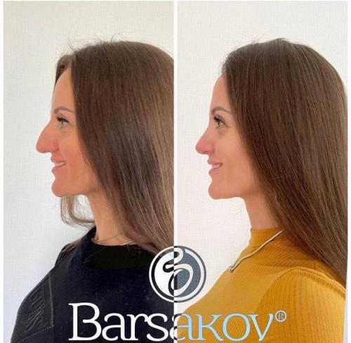 Таким образом, если ваш нос - вечный источник комплексов и плохого настроения, то после операции вы точно начнете оценивать себя по-другому. 09