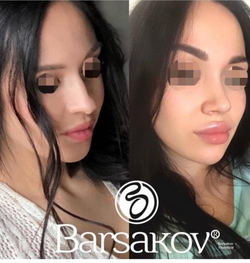 Таким образом, если ваш нос - вечный источник комплексов и плохого настроения, то после операции вы точно начнете оценивать себя по-другому. 03