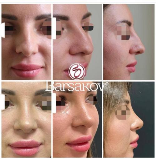 Таким образом, если ваш нос - вечный источник комплексов и плохого настроения, то после операции вы точно начнете оценивать себя по-другому. 06