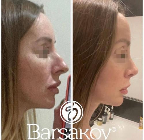 Таким образом, если ваш нос - вечный источник комплексов и плохого настроения, то после операции вы точно начнете оценивать себя по-другому. 02