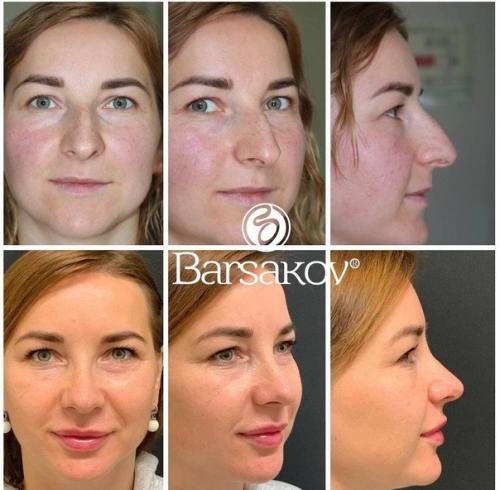 Таким образом, если ваш нос - вечный источник комплексов и плохого настроения, то после операции вы точно начнете оценивать себя по-другому. 05