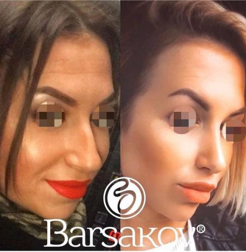 Таким образом, если ваш нос - вечный источник комплексов и плохого настроения, то после операции вы точно начнете оценивать себя по-другому. 01