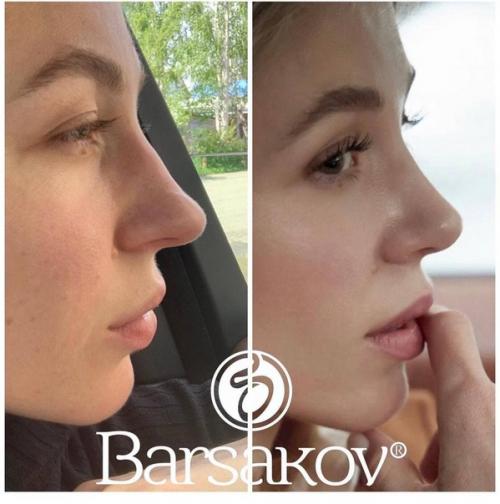 Таким образом, если ваш нос - вечный источник комплексов и плохого настроения, то после операции вы точно начнете оценивать себя по-другому. 04