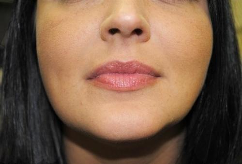 Как избавиться от носогубных складок. 01 Как избавиться от носогубных складок. 01