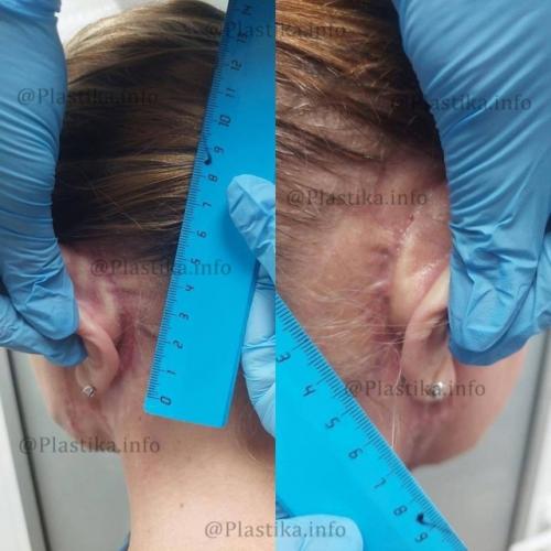 Мама виктории бони неудачной пластической операции подверглась. 02